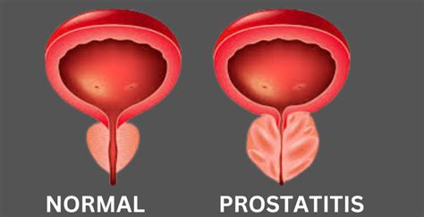 reddit prostatitis|prostatitis symptoms reddit.